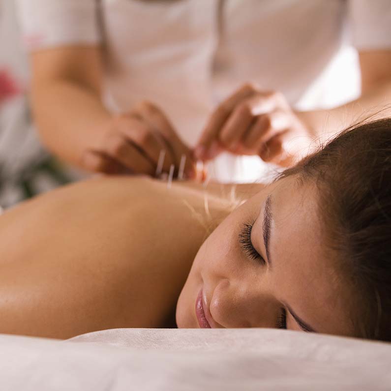 The doctor sticks needles into the woman's body on the acupuncture, close-up view